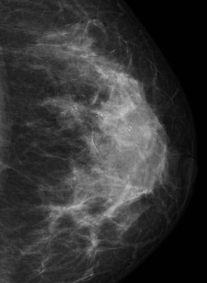 Distribución segmentaria. Microcalcificaciones pleomórficas y lineales. La biopsia estereotáxica demostró carcinoma ductal in situ de alto grado.