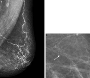 a. Calcificaciones vasculares. Corresponden a calcificaciones paralelas en las paredes vasculares, típicamente benignas. b. Calcificaciones vasculares. Cuando son iniciales suelen verse como una calcificación lineal en la periferia de una estructura tubular.