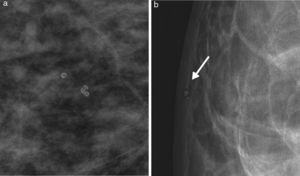 a. Calcificaciones cutáneas. Son calcificaciones poligonales, algunas redondas, con centro radiolúcido, típicamente benignas. b. Calcificaciones cutáneas. En esta proyección tangencial se hace evidente la ubicación superficial de estas calcificaciones (flecha blanca).