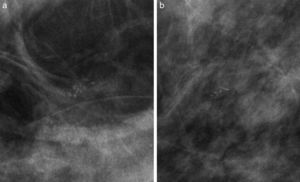 a. Calcificaciones en «l lechada de cal». En proyección cráneo-caudal se observan tenues y amorfas. b. Calcificaciones en «l lechada de cal». En proyección magnificada lateral estricta se visualizan en forma de menisco de concavidad superior. Es importante el cambio de morfología entre las dos proyecciones.