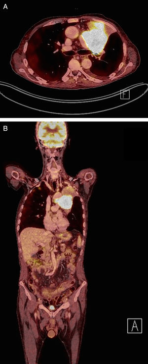 En las imágenes fusionadas de PET scan se demuestra una ávida captación del trazador FDG por parte de la masa pulmonar y el conglomerado adenopático mediastínico que obstruyen el bronquio lobar y generan el colapso del LSI. A) Corte axial. B) Reconstrucción coronal.