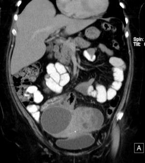 TC de abdomen y pelvis con contraste endovenoso en fase portal, y contraste oral positivo. Reconstrucción coronal. Lesiones sobre el útero, con relación al asa de íleon distal, con engrosamiento parietal concéntrico e hiperemia de la mucosa. Engrosamiento parietal del asa de colon sigmoides. DIU en cavidad endometrial.