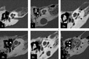 Graduación por TC de la otoesclerosis. Clasificación de Symons y Fanning13 para graduar el compromiso de la otoesclerosis. Grado 0: Normal. Grado 1: Solo compromiso fenestral. Grado 2: Compromiso coclear parcheado (2a: giro basal; 2b: ápice/giro medio; 2c: giro basal y ápice/giro medio). Grado 3: Compromiso coclear difuso. Todas las imágenes corresponden a cortes axiales de oído derecho en el nivel de la cóclea. Las cabezas de flecha señalan las áreas de hueso espongiótico.
