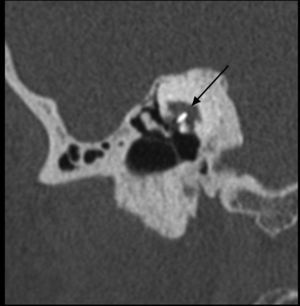 Prótesis de estribo. Prótesis parcial de estribo en paciente con otoesclerosis fenestral tratada. La imagen corresponde a una reconstrucción coronal oblicua del oído derecho. La flecha señala la prótesis, que se encuentra bien situada a nivel de la ventana oval.