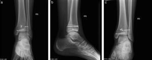 Radiografía de tobillo izquierdo del paciente de la figura 7, en proyecciones AP (a), lateral (b) y oblicua o mortaja (c). Se muestra FT de tobillo estabilizada con tornillos y aguja, con adecuado alineamiento de fragmentos óseos. Los rasgos de fractura son escasamente visibles, como signos de consolidacio¿n avanzada.