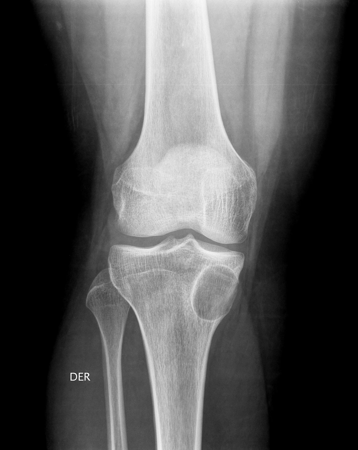 Anatom a De La Radiograf a De La Rodilla Radiograf a De Rodilla Ap