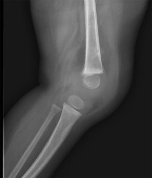 Artritis séptica. Radiografía en proyección lateral. Aumento de volumen en la articulación de la rodilla y derrame articular.