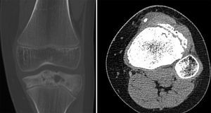 Osteomielitis. TC coronal en ventana ósea y axial en ventana de partes blandas. Aumento de la densidad e irregularidad de la cortical de la epífisis y metáfisis proximal de la tibia con presencia de un posible absceso de Brodie. Cuerpo extraño denso en el tejido celular subcutáneo en la porción anterior de la metáfisis proximal de la tibia.