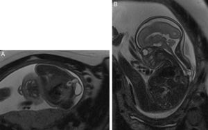 Mielomeningocele dorsal, en imágenes T2w HASTE axial (A) y sagital (B).