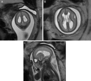 Colpocefalia, con prominencia de cuernos posteriores de ventrículos laterales, en imágenes T2w HASTE coronal (A), axial (B) y sagital (C).
