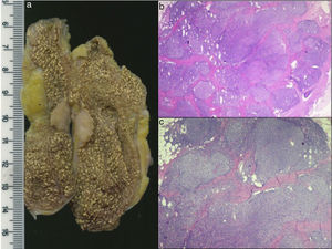 a) Pieza quirúrgica, con un nódulo sólido en la pared vesicular de 17×15×8 mm, blanquecino-amarillento. Asociado a colecistitis crónica y colesterolosis. b y c) Histología, tinción con hematoxilina y eosina: proliferación linfoide atípica polimorfa, no encapsulada, ubicada en la mucosa, submucosa y capa muscular. Compuesto por células linfoides pequeñas, con núcleos ovoideos uniformes, citoplasma eosinófilo pálido. Se realizó estudio inmunohistoquímico que resultó compatible con linfoma no Hodgkin de células B de la zona marginal.