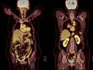 PET/CT 18F-FDG de cuerpo completo: sin evidencia de focos de captación anormal del trazador.