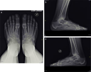 Coalición talonavicular bilateral. Proyección anteroposterior de los pies (a) y laterales (b y c), que muestra fusión ósea entre los huesos navicular y astrágalo.