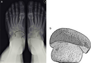 a y b) Signo de la Seta en la coalición talonavicular, en proyección anteroposterior del pie. Al seguir los contornos de la fusión ósea entre los huesos navicular y astrágalo se obtiene una imagen que remeda la forma de una seta.