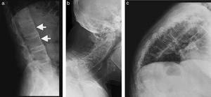 Proyecciones laterales de radiografías de columna de un mismo paciente. Izquierda (a): cuadratura de cuerpos vertebrales de columna lumbar, con pérdida de su normal concavidad anterior (flechas). A la derecha (b y c) el mismo fenómeno, determinado por sindesmófitos.
