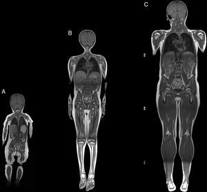 Imágenes de cuerpo completo T1w coronal. (A) Paciente de 10 meses de edad, FOV=28cm; (B) paciente de 6 años de edad, FOV=36cm; (C) paciente de 35 años de edad, FOV=36cm.