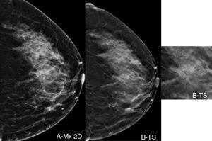 A)Proyección craneocaudal (CC) de mamografía digital de la mama izquierda con tejido heterogéneamente denso (ACR C), sin evidencia de lesiones focales. B)Corte de tomosíntesis en proyección CC izquierda de la misma paciente, que muestra distorsión arquitectural de 15mm oculta en 2D, cuyo estudio histológico reveló CDI gradoii.