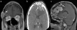 Metástasis durales en los agujeros de trepanación (flechas): a)imagen coronal T1 post gadolinio: DM por neuroblastoma olfatorio; b)imagen axial de TC con contraste: DM por carcinoma nasosinusal indiferenciado; c)imagen sagital T1 post gadolinio: DM de carcinoma adenoideo quístico.