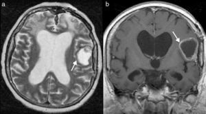 Metástasis durales de neuroblastoma olfatorio con patrón quístico (flechas): a)imagen axial T2; b)imagen coronal T1 con gadolinio.