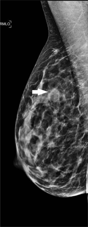 Imagen de mamografía de proyección medio lateral oblicua de la mama derecha, donde se observa en el cuadrante superior (flecha) un nódulo redondeado, de márgenes oscurecidos, isodenso.