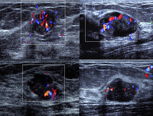 Ultrasonido con Doppler color que demuestra la vascularización interna de 4 diferentes hamartomas mioides.