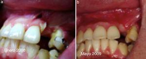 a) Paciente de 19 años, enero 2008 secuela trauma maxilo facial. b) Mayo 2009 estabilidad tisular poscirugía reconstructiva.