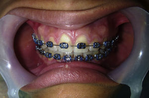 Agrandamiento gingival en individuo con aparatología ortodóncica fija.
