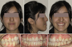 Paciente de sexo femenino, de 23 años. Aspecto clínico extra e intraoral. Nótese la facies progénica y la pobre base apical de la maxila.
