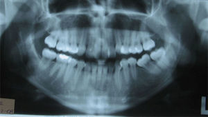 Radiografía panorámica. Se observa una apropiada longitud radicular. Ausencia de 3.6 con mesialización de 3.7.