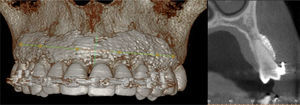 Cone beam maxilar. Vista 3D de la zona con relleno de vidrio bioactivo que permanece sin reabsorber después de un año de la cirugía y vista radioopaca del FillerBone®.