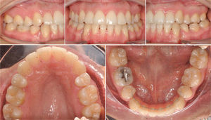 Fotografía intraoral final, después de un año de la corticotomía con relleno de vidrio bioactivo.