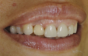 Paciente clase iiesqueletal con incompetencia labial, respiradora bucal con un exceso vertical del maxilar superior y línea de la sonrisa alta según Hochman et al.18.