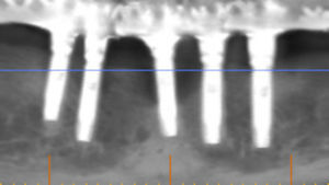 Radiografía con implantes en fallo e indicación de remoción.