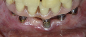 Imagen clínica del implante con roscas expuestas.