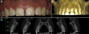 A. Aspecto general del sector estético maxilar anterior; se observa una dimensión reducida de las coronas clínicas en el sentido inciso-cervical y un biotipo periodontal grueso. B. Aspecto general frontal de la zona maxilar anterior a través de un ConeBeam TC, donde se observa la estrecha relación entre el LAC y el hueso alveolar bucal, en el cual la distancia entre estas estructuras es menor a 1mm, confirmando nuestro diagnóstico inicial. C. Corte sagital de los dientes anteriores maxilares (cortes 43-45; 81-83); se observa una distancia menor a 1mm entre LAC y hueso alveolar en la zona bucal previo a la intervención. Además se puede observar el grosor del tejido óseo alveolar bucal.