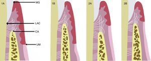 Coslet et al.5 clasificaron morfológicamente EPA en 2 tipos de acuerdo a la localización de la unión mucogingival con respecto a la cresta ósea, y observaron 2 subtipos en referencia a la posición de la cresta ósea con respecto al LAC. En el tipo 1 (1A y 1B) hay un excesivo solapamiento del margen gingival en la corona, la dimensión de la encía queratinizada es considerable y la unión mucogingival se encuentra más apical a la cresta ósea. En comparación con el tipo 2 (2A y 2B) la banda gingival queratinizada es estrecha, la unión mucogingival coincide con el nivel del LAC. Ambos tipos son a su vez clasificados en subtipos A y B. En el subtipo A (1A y 2A) la distancia entre la cresta ósea y la unión cemento-esmalte es de 1,5-2mm (que permite una dimensión normal de fijación de fibra conectiva en el cemento radicular), mientras que en el subtipo B (1B y 2B) la cresta ósea se encuentra muy cerca, o incluso en el mismo nivel que el LAC.