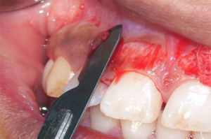 Gingivoplastia con bisturí en posición paralela al periodonto.