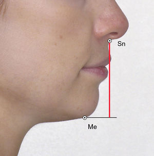 Dimensión vertical oclusal, medida desde Subnasal a la proyección horizontal de Menton.