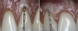 Biotipo periodontal medido mediante transparencia de la sonda: a) biotipo grueso, no se observa contorno de la sonda subyacente al margen gingival; b) biotipo fino, se observa contorno de la sonda subyacente al margen gingival.