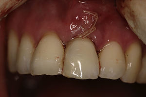 Cirugía (implante, injerto de tejido conectivo y provisionalización con el diente de la paciente).