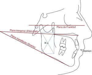 Puntos y planos cefalométricos utilizados en este trabajo.