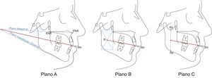 Planos propuestos: el plano A va desde la intersección de los planos palatino y mandibular hasta Stomion. El plano B se traza desde Xi hasta Stomion, y el plano C, desde el punto medio entre R3 y R4 hasta Stomion.