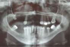 Ortopantomografía posterior a exodoncias.