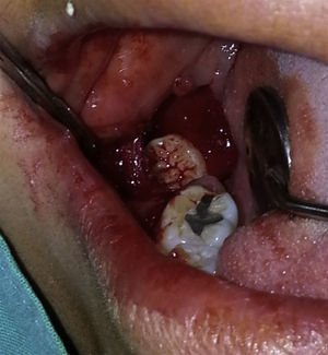 Se observa la pieza 4.8 (tercer molar inferior derecho) desplazada luego de la exéresis de la lesión.