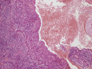 HE ×10. Mucosa oral con proceso inflamatorio crónico activo acentuado, en relación con odontoma erupcionado.