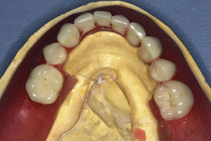 Enfilado dentario sobre modelo de trabajo con recorte de flanco lingual entre los premolares.