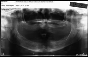 Ortopantomografía inicial preoperatoria.