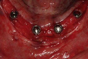 Implantes de hexágono interno instalados.