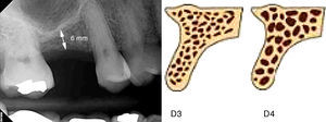 Radiografía periapical (zona primer molar superior) que muestra una disponibilidad ósea vertical de 6mm (izquierda); esquematización de densidad ósea tipo 3 y tipo 4 (derecha).