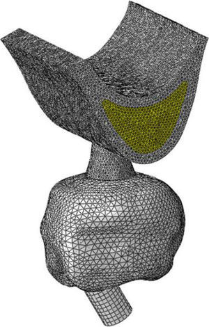 Esquematización del modelo 3D en el que se observa adherido a la corona la pieza adicional.